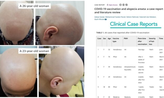 Cases of Alopecia (Hair Loss) Explode Following COVID-19 Vaccines