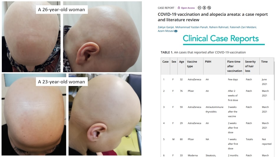 Cases of Alopecia (Hair Loss) Explode Following COVID-19 Vaccines